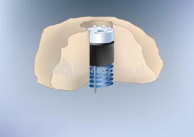 LED-kop Koud Wit Voor Quellstar 600 6 LED-kop Koud Wit Voor Quellstar 600 - Afbeelding 4